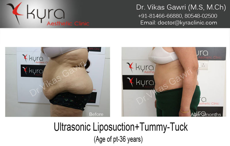 Post Pregnancy Tummy Tuck Surgery in Chandigarh, Punjab, India- Doctors Near  Me