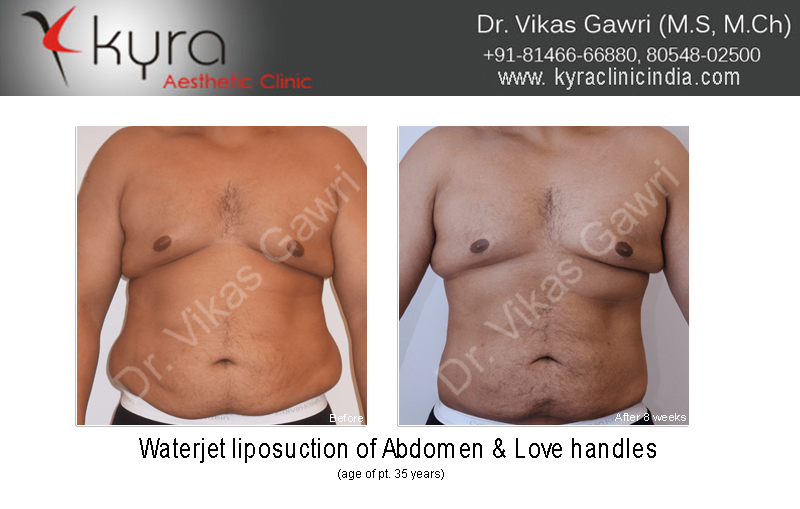 Breast Surgery Archives - Cosmetic Surgery in Ludhiana, Plastic Surgery in  Punjab, Breast Surgeon in Ludhiana, Punjab, India
