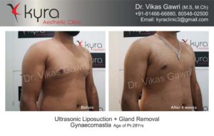 cost of gynecomastia in punjab