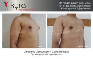 cost of gynecomastia in punjab