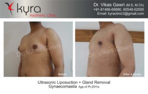 cost of gynecomastia in punjab