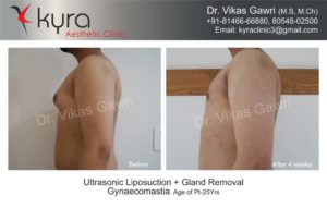 gynecomastia in punjab