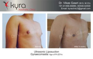 gynecomastia in punjab