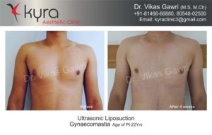 gynecomastia in punjab