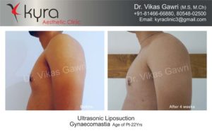 gynecomastia in punjab