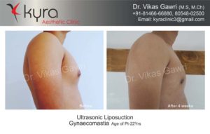 cost of gynecomastia in punjab