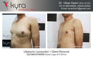 gynecomastia in punjab