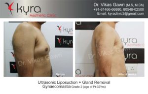 gynecomastia in punjab