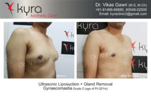 gynecomastia in punjab