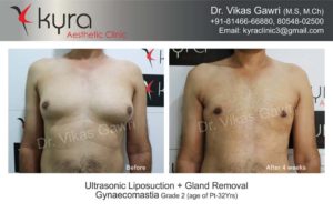 gynecomastia in punjab