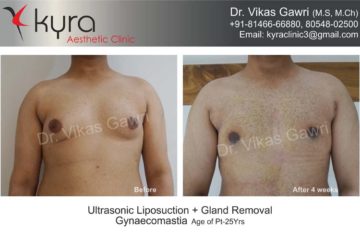 male breast reduction in ludhiana