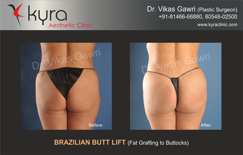 Brazilian Butt Lift Surgery in Mumbai: Enhance Your Curves with Dr