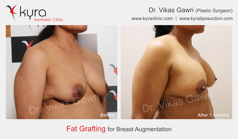 Fat Transfer Breast Augmentation India
