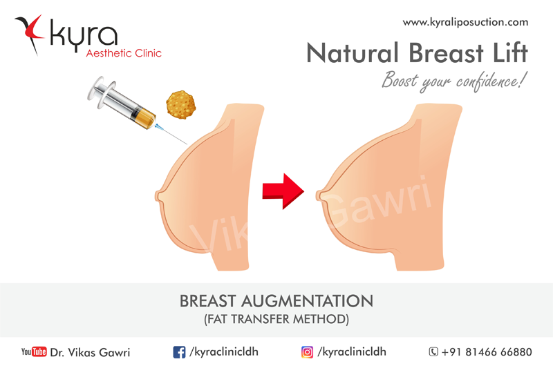 Fat Transfer Breast Augmentation