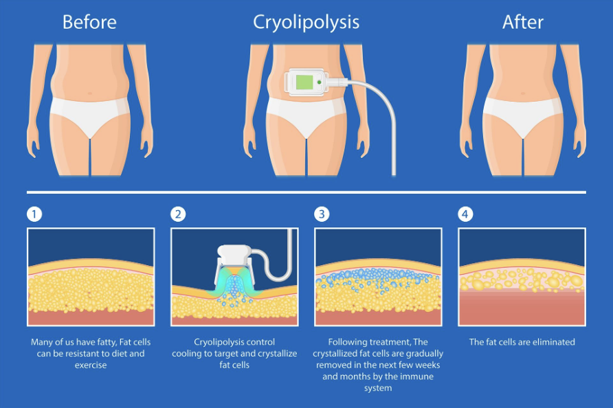 Fat Freezing & Body Fat Removal : CoolSculpting®